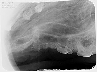 Complicated and surgical extraction X-ray