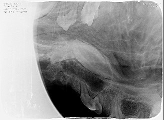 Complicated and surgical extraction X-ray