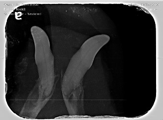 Complicated and surgical extraction X-ray